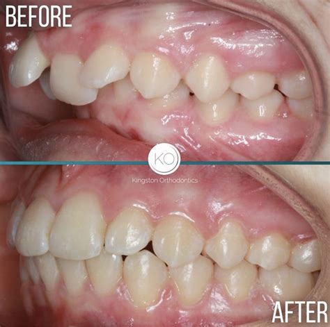 Discover How Braces Effectively Correct Overbites