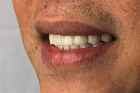 Dental Crown And Bridges Malaysia | mydentist®