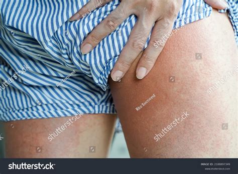 123 Thigh Acne Images, Stock Photos & Vectors | Shutterstock