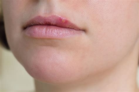 What Causes Cold Sores On Lips And How To Prevent Them | Lipstutorial.org