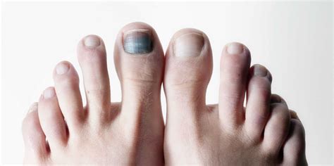 Swirlster First: Why Do Toenails Turn Black