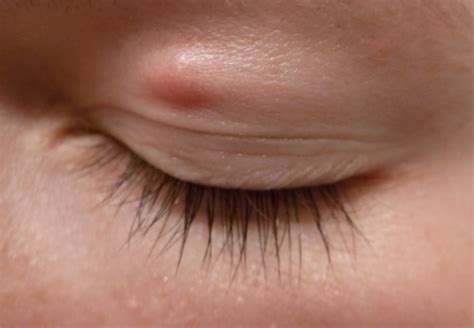 Balls Under Eyelids at Casey Hall blog