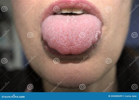Tongue Is White With Bumps