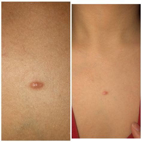 Types Of Pimples On Chest at Daniel Beaty blog