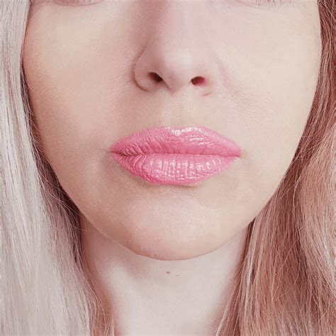 Lip Fillers in Montreal - Lip Injections & Augmentation