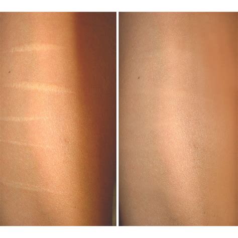 Treat Self Harm Scars in London | 25 Years Harley Street Expertise