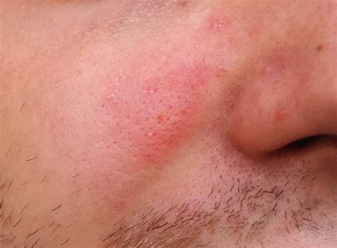 Dry Spots