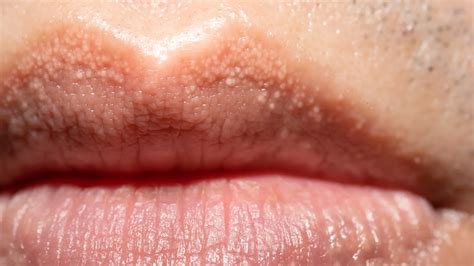 ¿Qué son las manchas o granos de Fordyce?