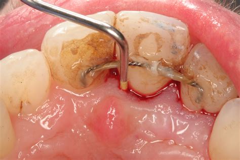 Abscessed Tooth Drainage