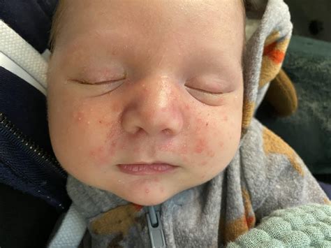 Currently breastfeeding my 4 week old. Wondering if baby acne like this ...