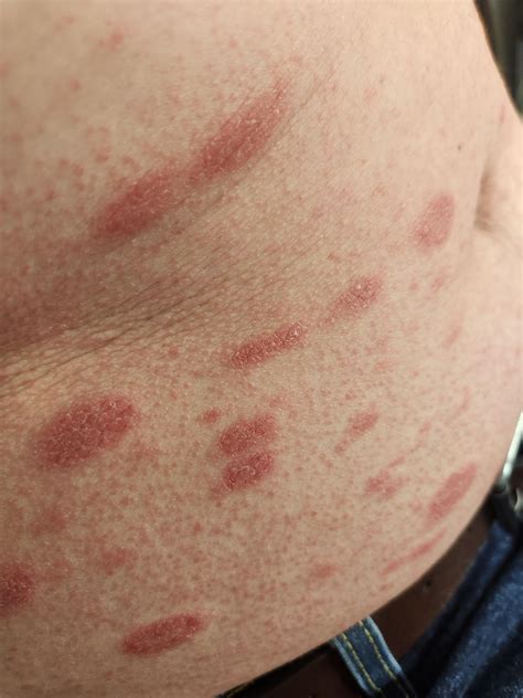 Tinea Versicolor Armpit at Angelica Harris blog