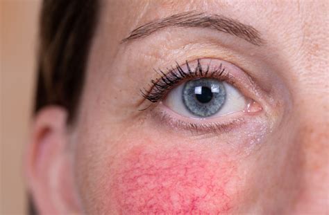 Is Rosacea Autoimmune? | Sea View Optometry