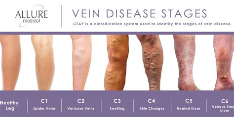 Varicose Veins | Allure Blog