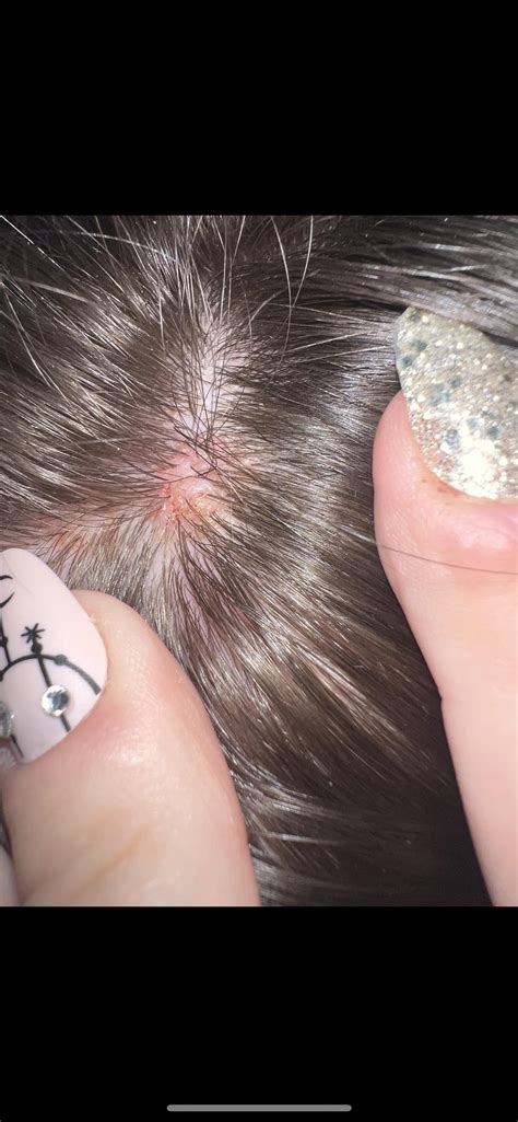 I have 2 hard lumps on my scalp (picture is the worse of the 2) Almost feel like lipomas.I have ...