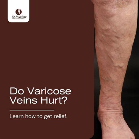 Do Varicose Veins Hurt? Learn How You Can Get Relief | Dr.Mackay