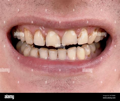 Smiling mouth of man with crooked yellow teeth close-up. Unhealthy worn ...