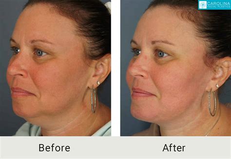 Best Plastic Surgeon For Lower Face Lift at Ha Overton blog