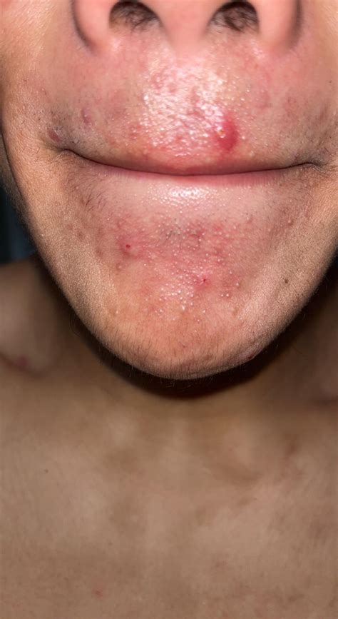 Fungal acne around mouth? : r/DermatologyQuestions