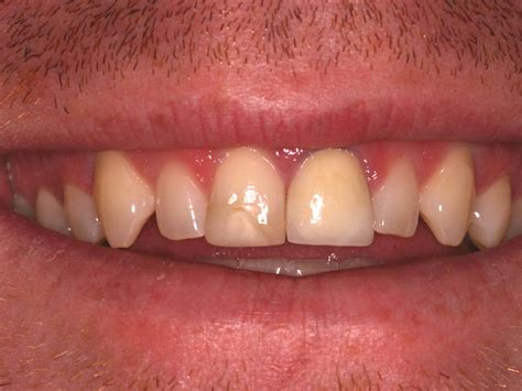 Front Teeth Restored using Dental Crowns in Traverse City