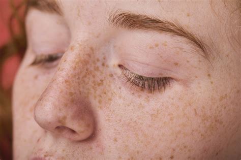 Freckles: Genetics and Other Causes