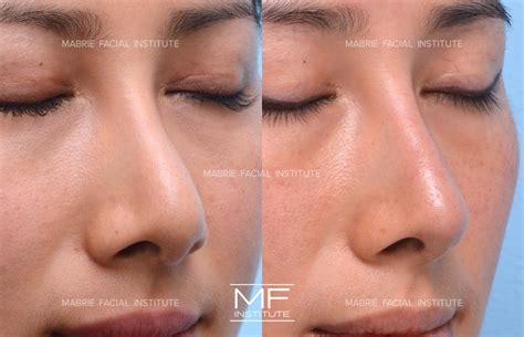 4 Ways To Make Your Nose Appear Smaller With Filler | Mabrie Facial ...