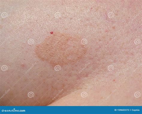 Photos of Fungal Skin Rash: What You're Likely Seeing and What to Do ...