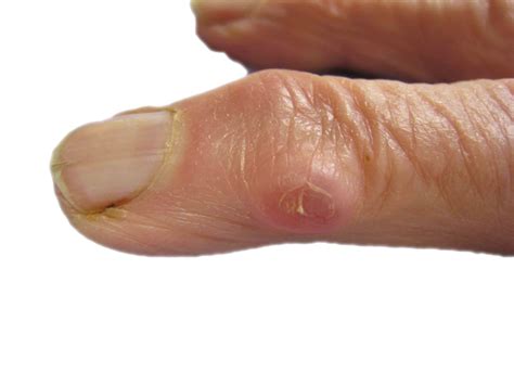 Sebaceous Cyst Finger at Carlos Harper blog