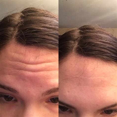 [routine help] 21 with forehead wrinkles? : r/SkincareAddiction