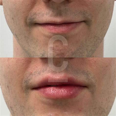 Understanding 1ml Lip Filler Impact - Cosmetic Connection
