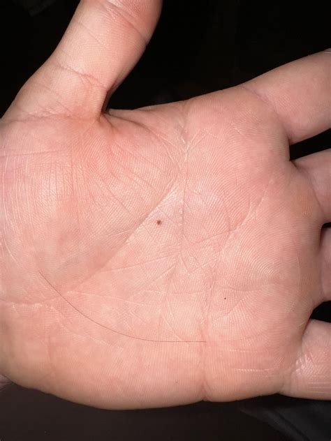 Mole or freckle on palm? : r/Melanoma