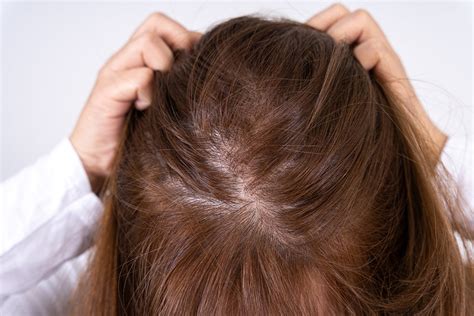 How a Dry Scalp Can Lead to Hair Loss - DS Healthcare Group