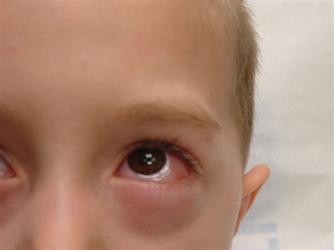 Chemosis | Visual Diagnosis
