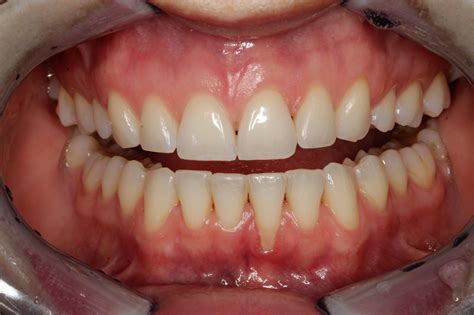 Understanding Gum Recession: Causes, Symptoms, Prevention, and Treatment — Nova Smiles