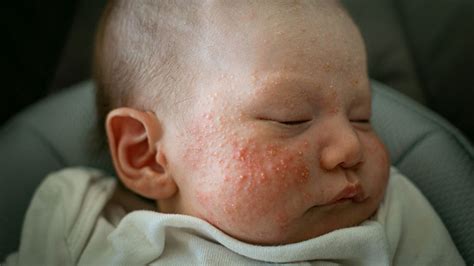 Yeast Acne Baby