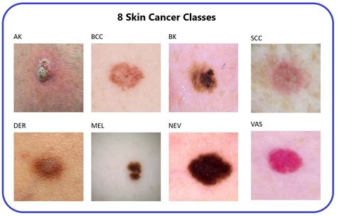 Naturalize Revolution: Unprecedented AI-Driven Precision in Skin Cancer Classification Using ...