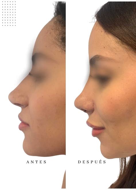 Rinoplastia – Cirugia De Nariz - Cirujano Plastico Jarold Effer