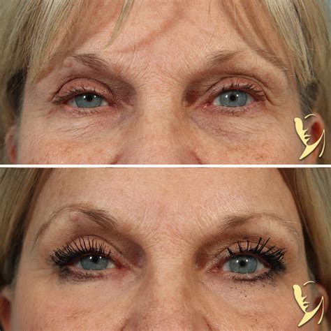 Erbium Laser Skin Resurfacing | Atlanta, GA | Dr. Burke Robinson