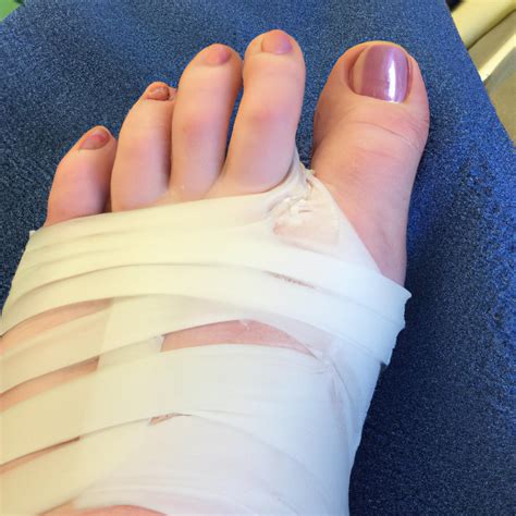 Immediate Relief After Foot Surgery and Understanding the Post Op Phase