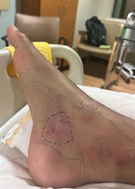 How to Survive Venomous Copperhead Snake Bite