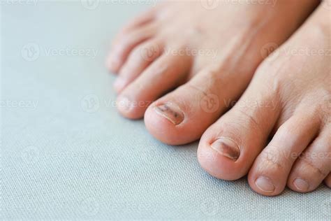Subungual Hematoma on toenail are injuries of wearing shoes that are ...
