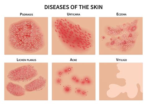 Eczema Vs Psoriasis