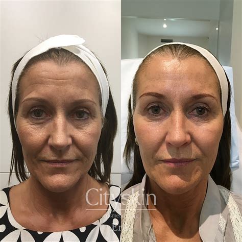 Full Facial Rejuvenation Treatment Melbourne - Cityskin