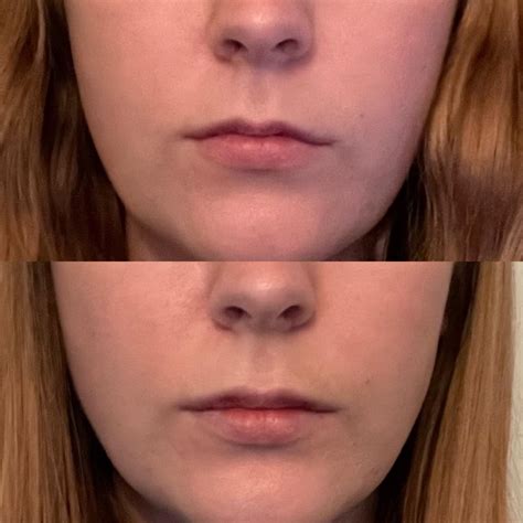 O.5 Ml Lip Filler Lip Filler Before & After Results Skinly