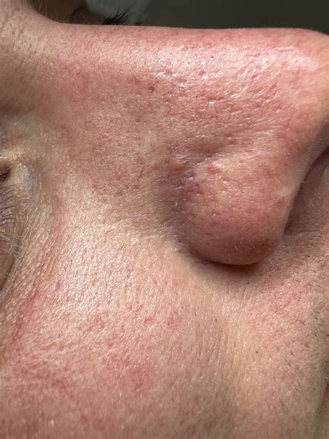 How do i get rid of fibrous papules | Looksmax.org - Men's Self ...