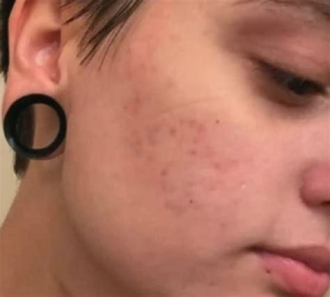 Acne Wash Benzoyl Peroxide 4% | PanOxyl CA