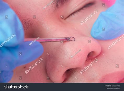 Removing Comedones On Nose