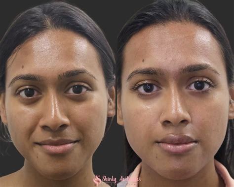 Smile Line Fillers - Before & After Results at Skinly