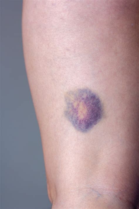 Skin Bruising Images - Free Download on Freepik