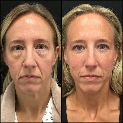 Lower Blepharoplasty Before & After Photos | Flora Levin MD