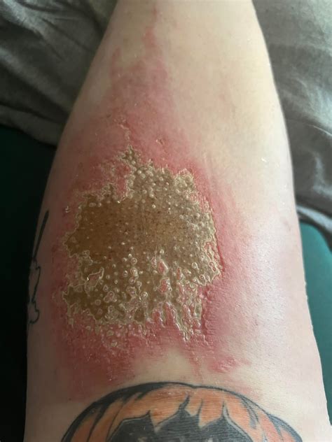 Road rash healing process : r/woundcare